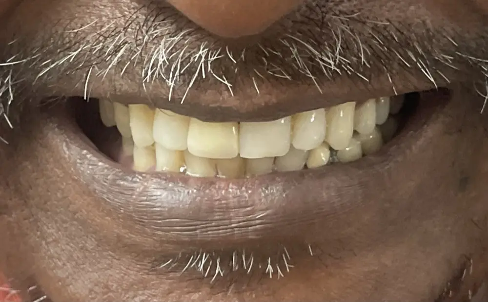 The same smile with the gap closed by a colour-matched ceramic crown