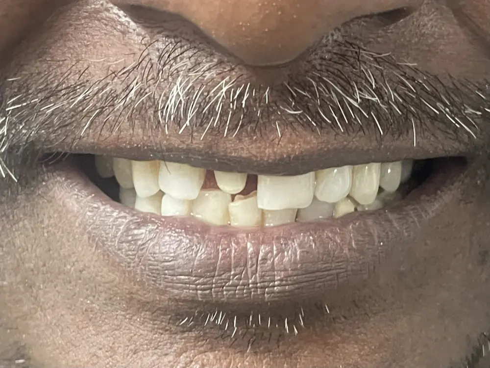 Upper front teeth with a visible gap where a tooth is missing