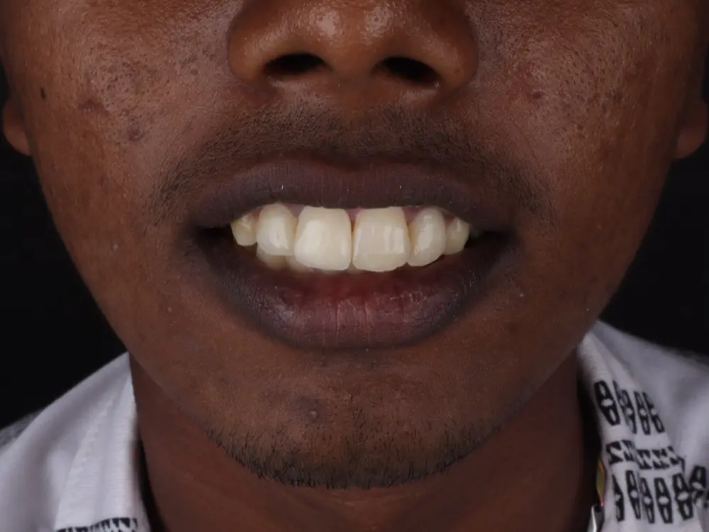 The same upper arch, evenly aligned and free of staining