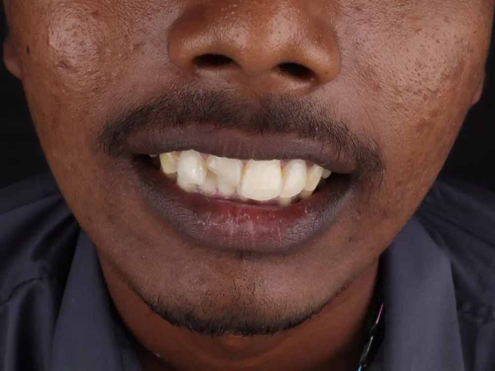 Crowded, overlapping upper front teeth with surface staining