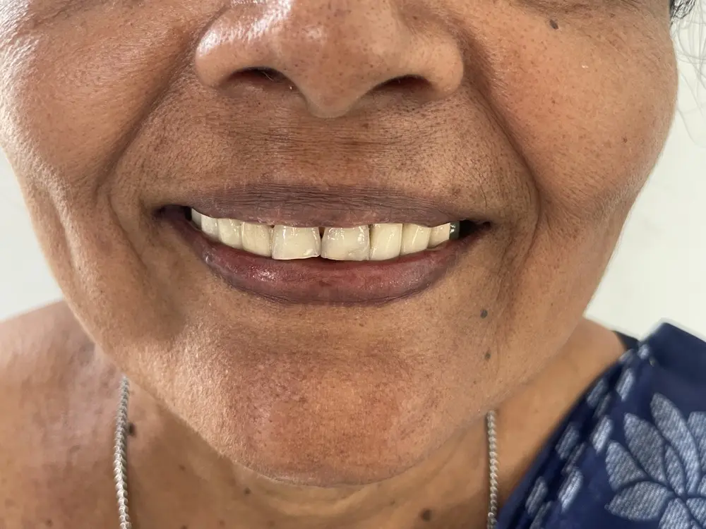 The same teeth rebuilt to an even edge with the gaps closed
