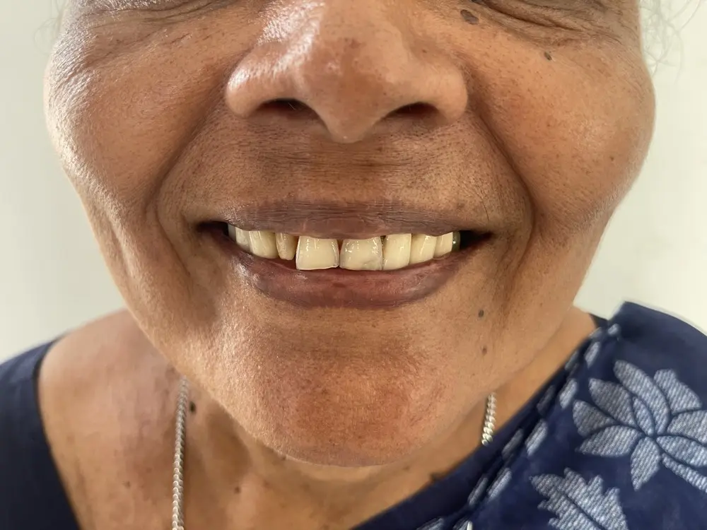 Upper front teeth with worn, uneven edges and dark gaps between them