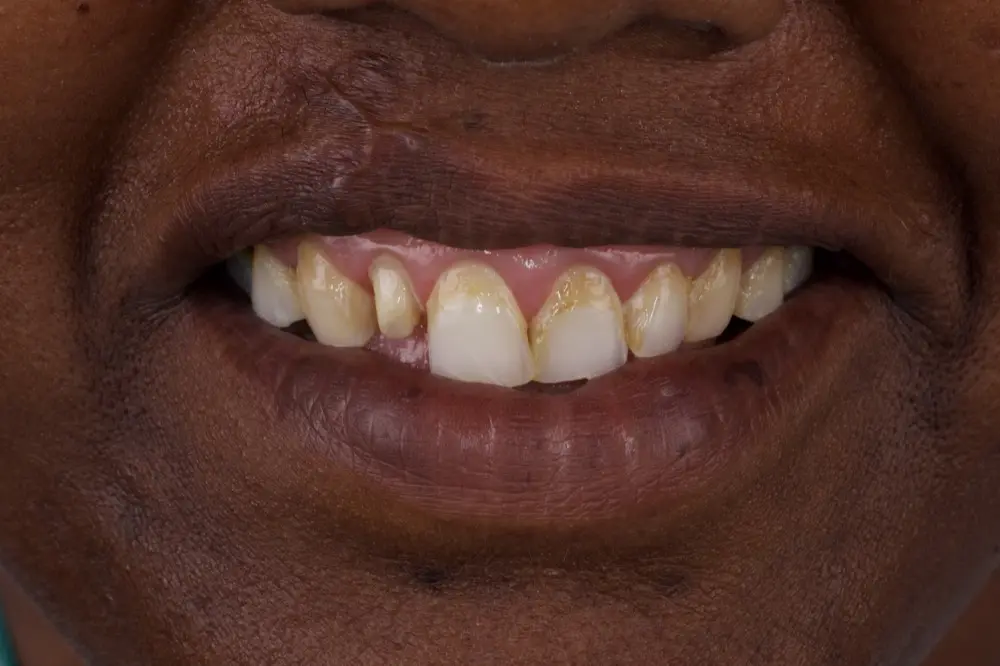 Teeth with heavy tartar build-up along an inflamed, swollen gum line