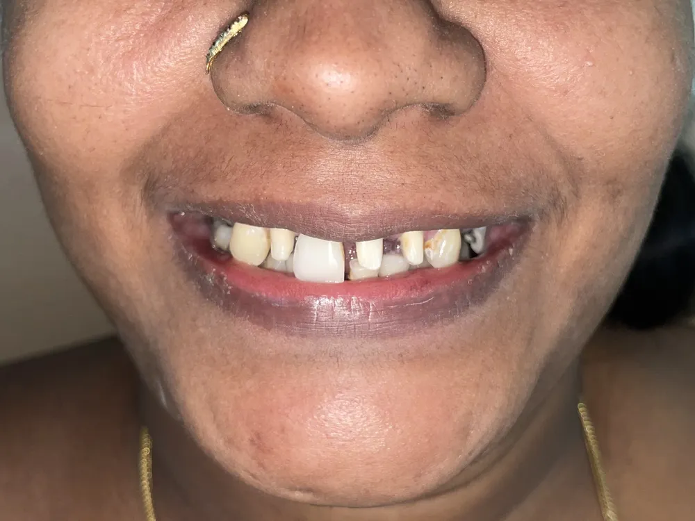 Upper front teeth with a gap between them and uneven, discoloured edges