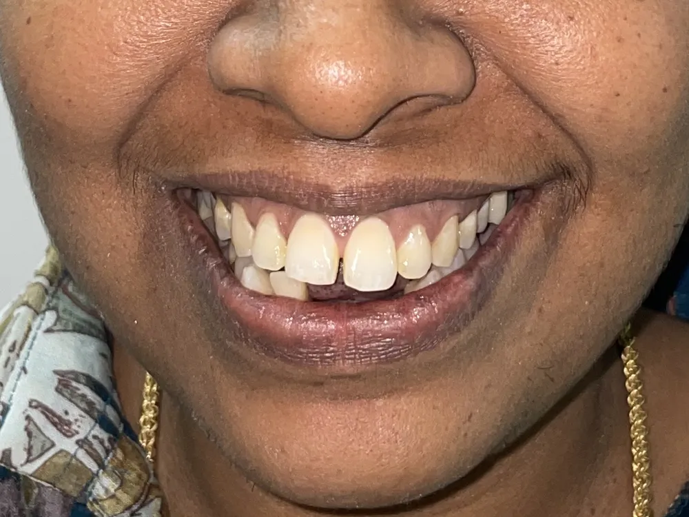 A smile with a visible gap between the two upper front teeth and uneven edges